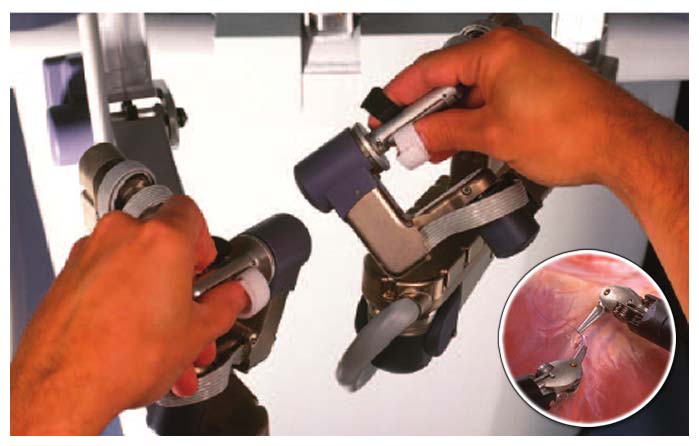 Close-up of robotic surgery hand controls during delicate procedure.