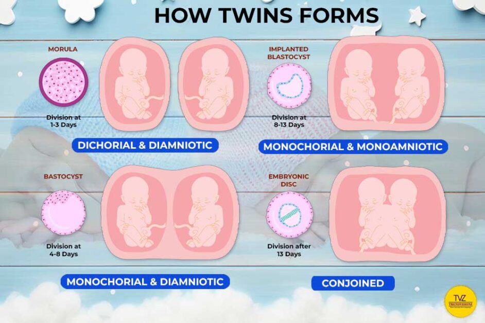 Infographic on types of twin pregnancies