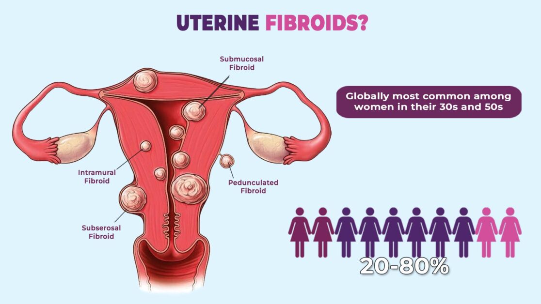 signs of hormonal imbalance: fibroids