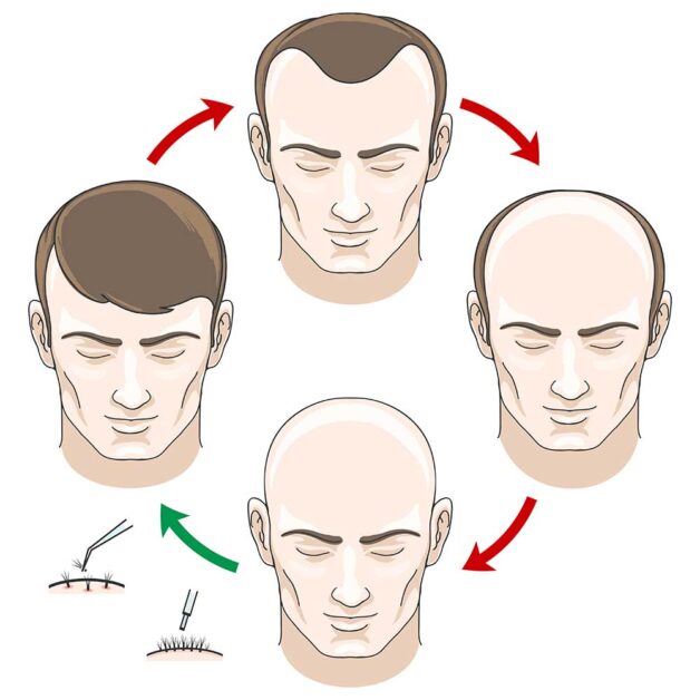 what causes baldness