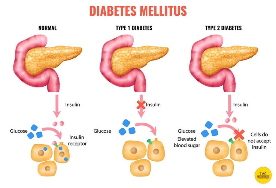 Illustration of insulin function in normal, Type 1, and Type 2 diabetes.