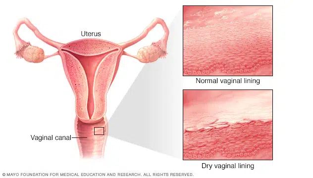 Menopause Symptoms