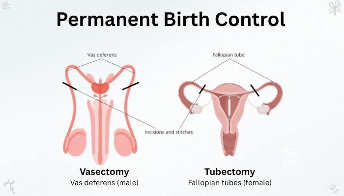 Illustration comparing vasectomy and tubectomy as permanent contraception methods